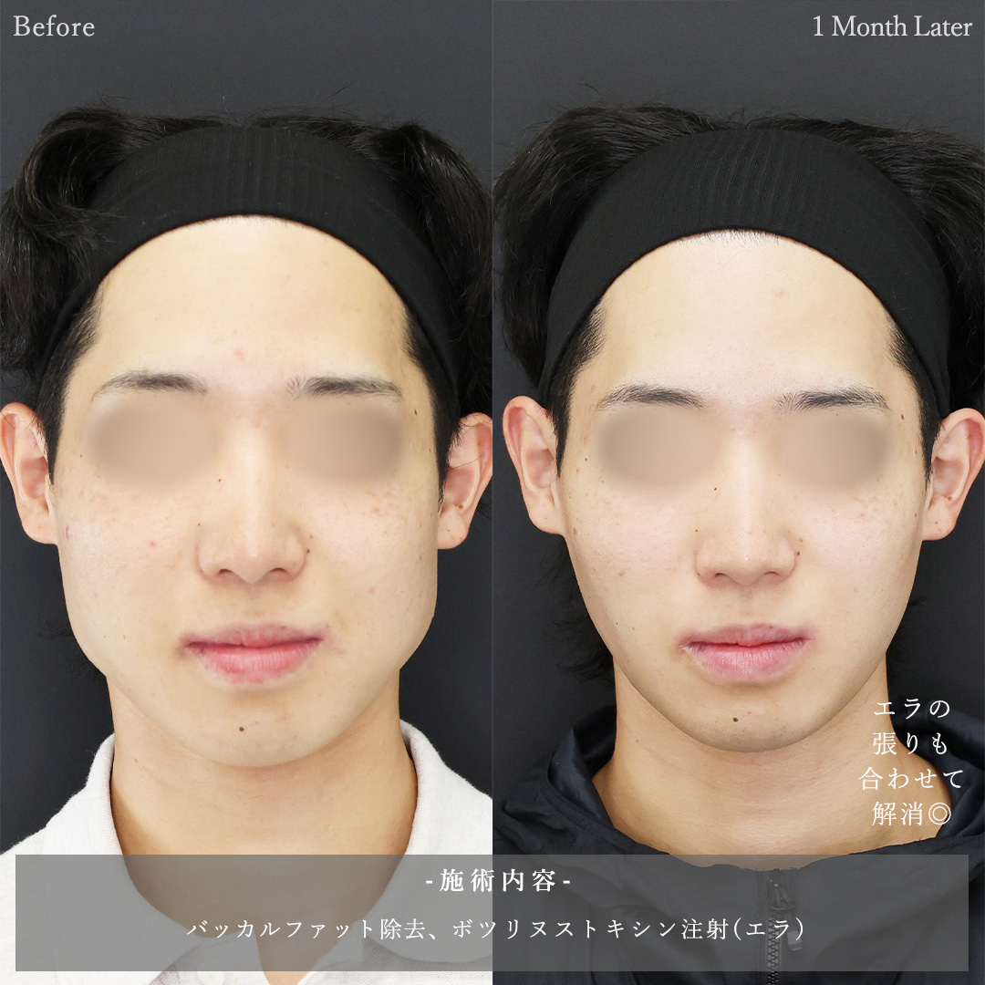 バッカルファット除去/エラボトックス注射の症例写真 施術前後 