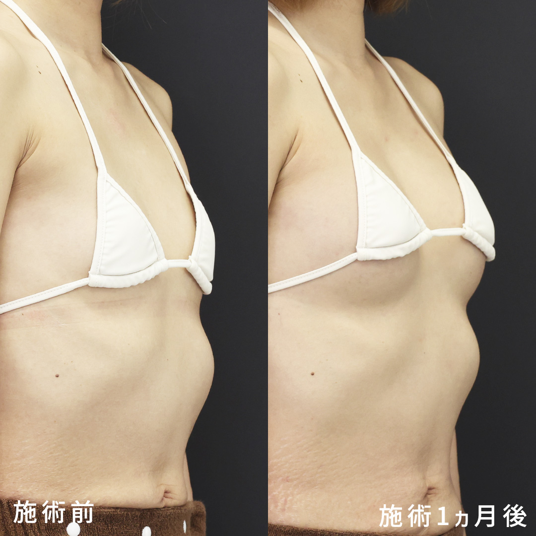 脂肪注入で授乳後のお胸もナチュラルに【脂肪注入豊胸術】