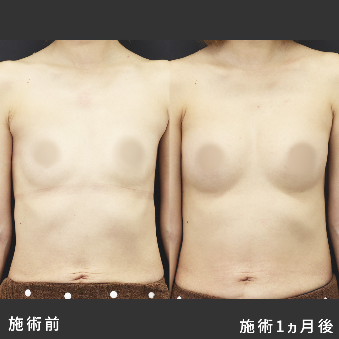 脂肪注入豊胸（コンデンスリッチ・ピュアグラフト・１day脂肪豊胸）の症例写真 施術前後 