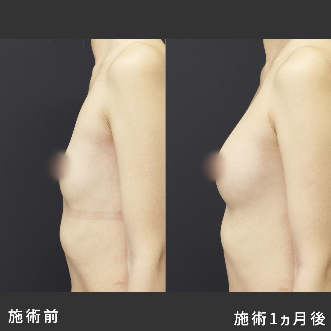 脂肪注入豊胸（コンデンスリッチ・ピュアグラフト・１day脂肪豊胸）の症例写真 施術前後 