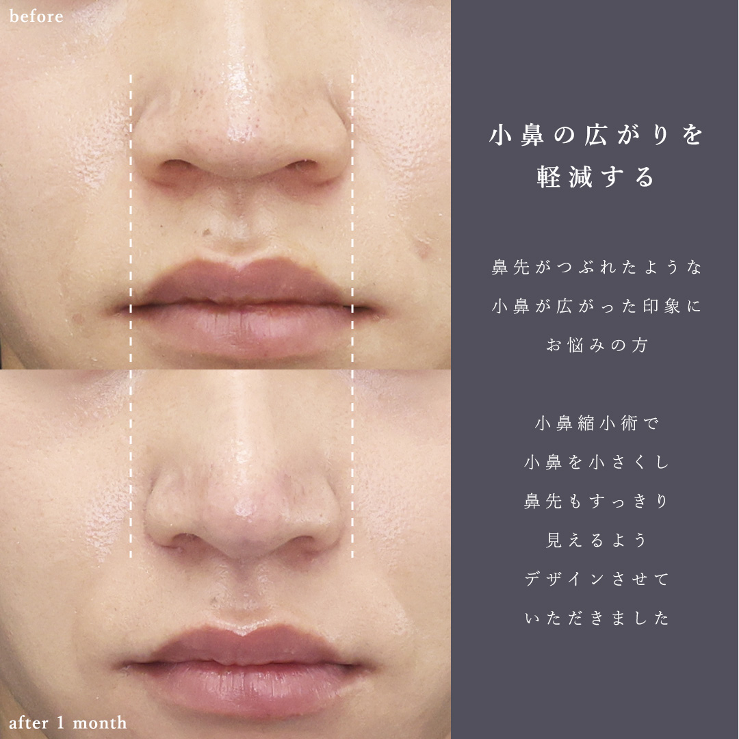 鼻尖形成・鼻尖縮小/TAC式 鼻翼縮小術(小鼻縮小)の症例写真 施術前後