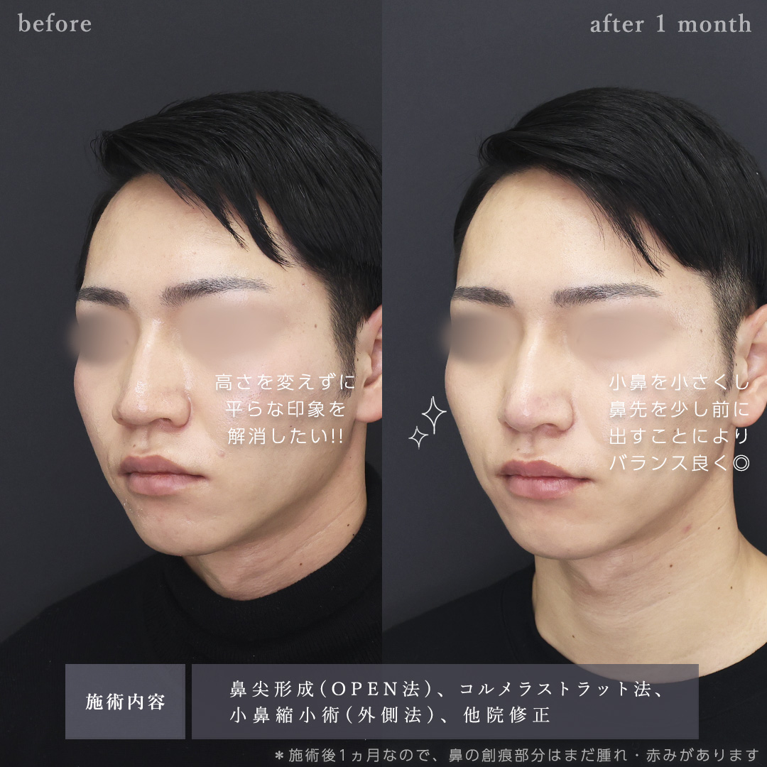 鼻尖形成・鼻尖縮小/TAC式 鼻翼縮小術(小鼻縮小)の症例写真 施術前後