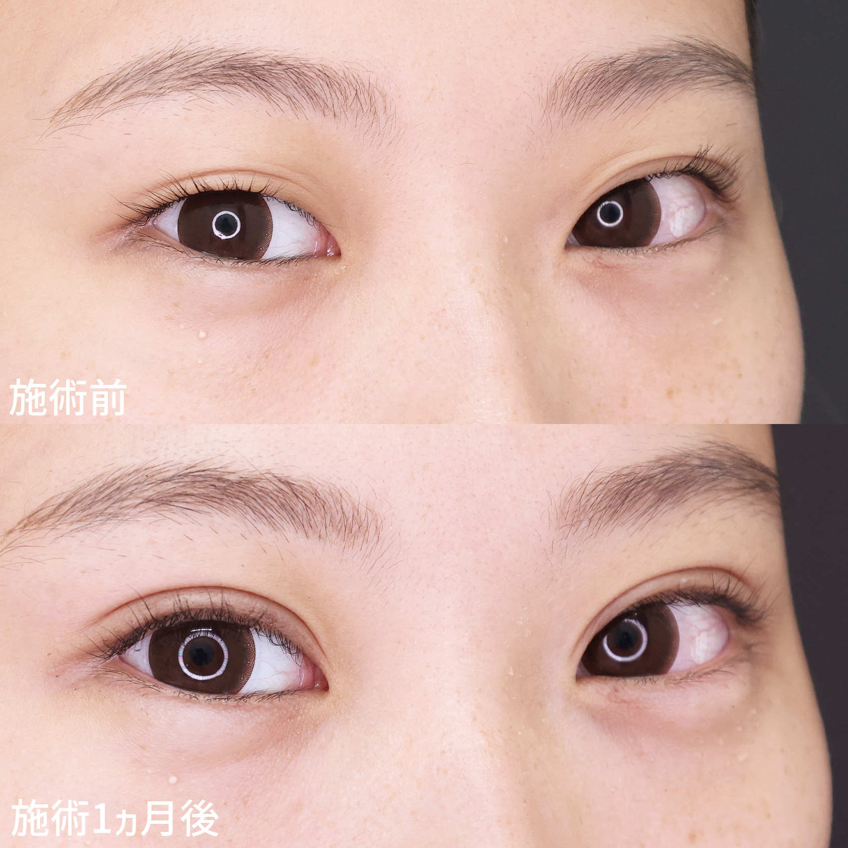 二重埋没法/涙袋形成（ヒアルロン酸注射）の症例写真 施術前後 