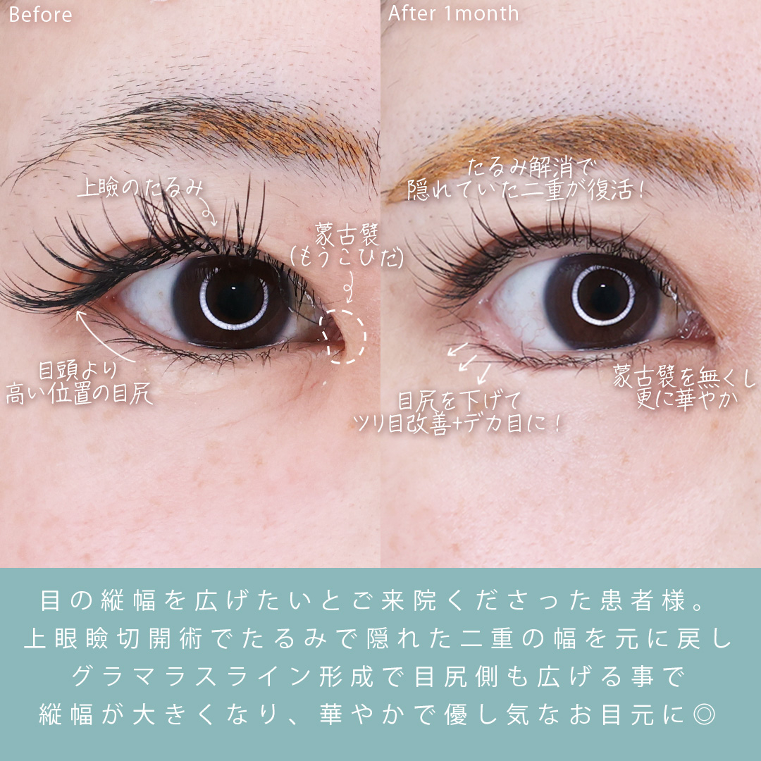 グラマラスライン（タレ目形成）/上眼瞼切開術/目頭切開術の症例写真 施術前後 
