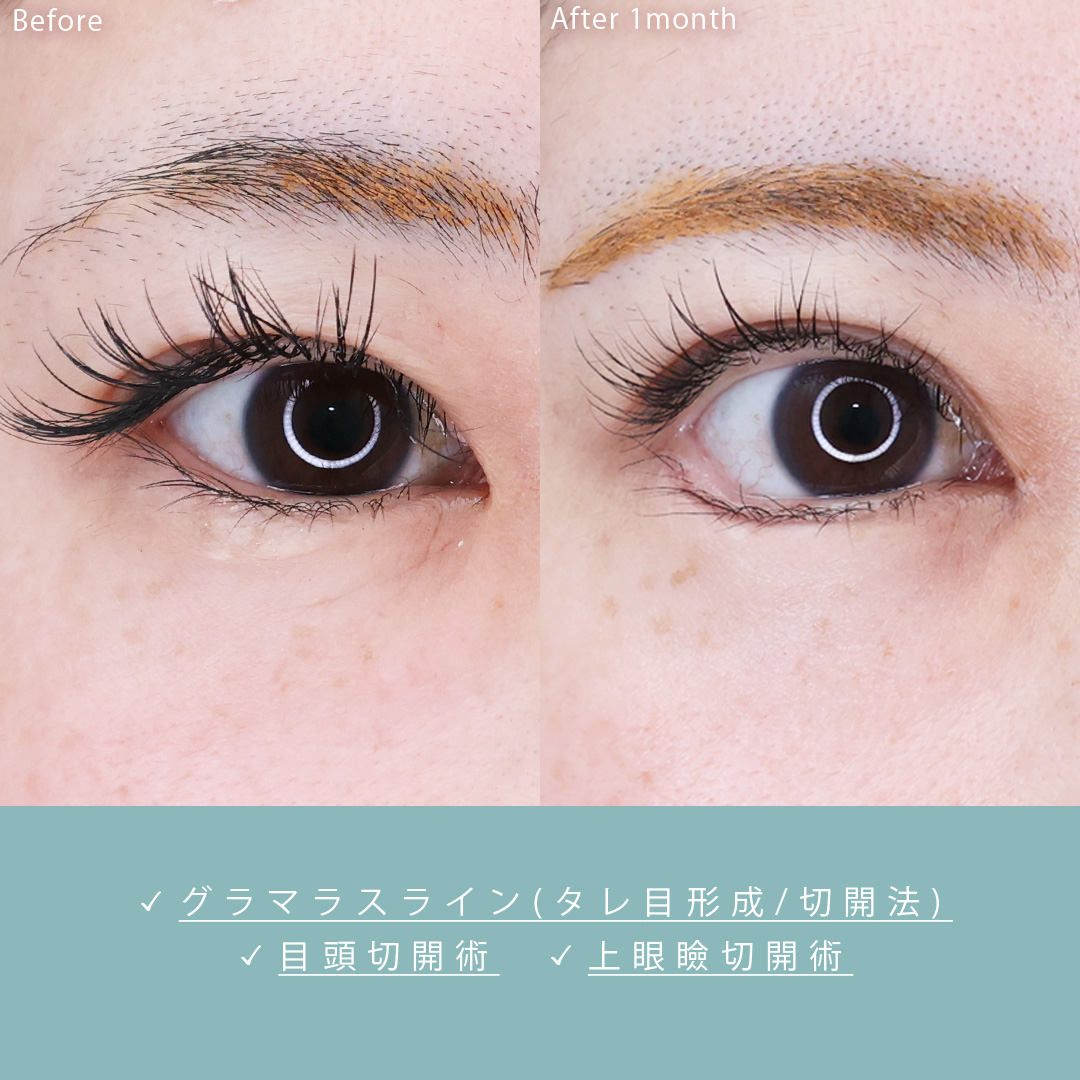 グラマラスライン（タレ目形成）/上眼瞼切開術/目頭切開術の症例写真 施術前後 