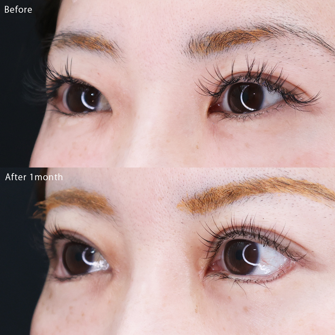 グラマラスライン（タレ目形成）/上眼瞼切開術/目頭切開術の症例写真 施術前後 