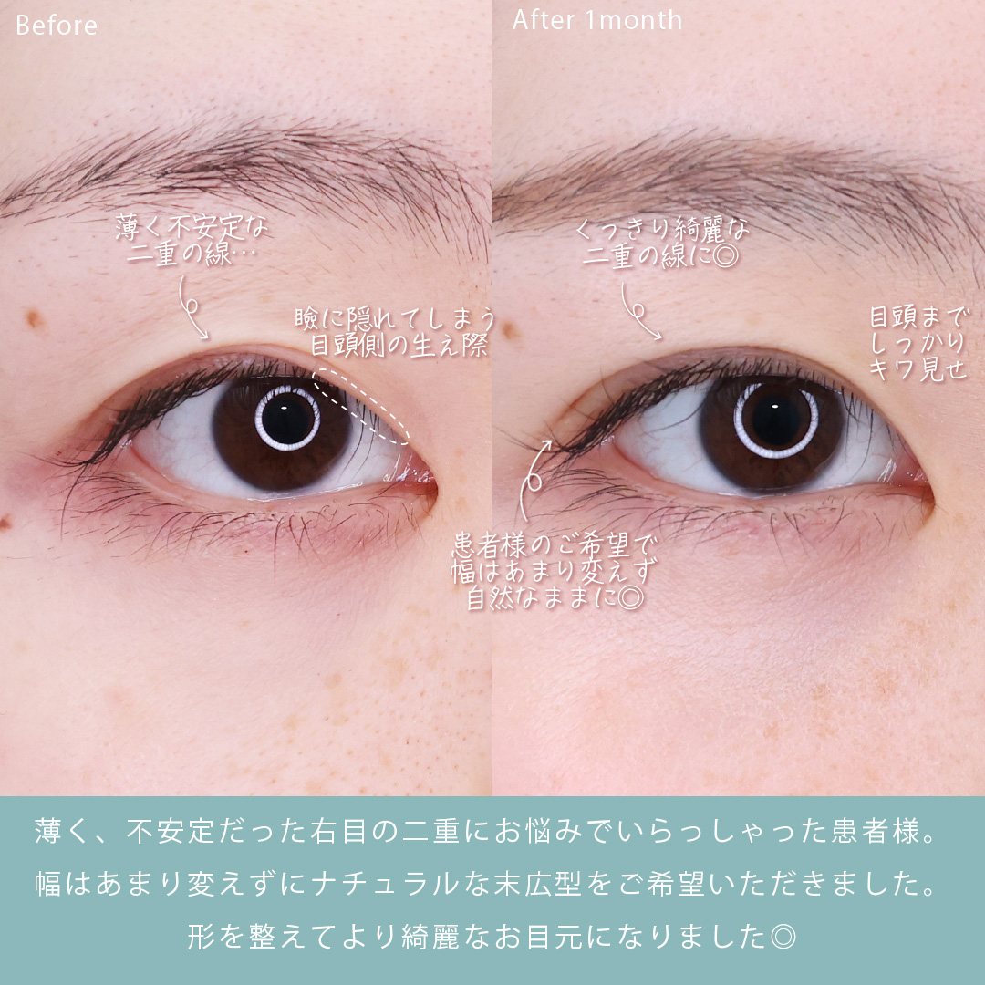 二重埋没法の症例写真 施術前後 