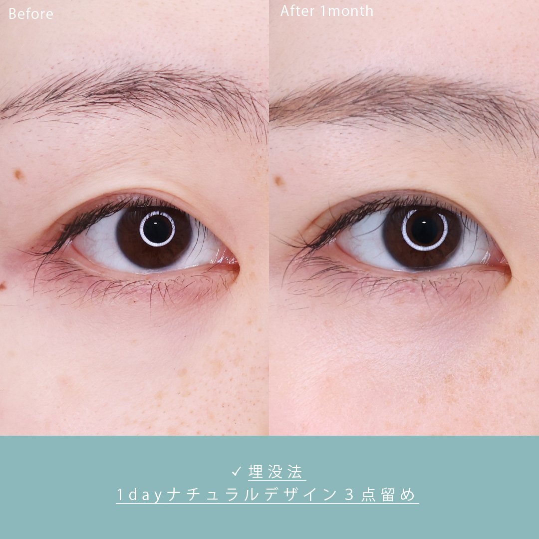 二重埋没法の症例写真 施術前後 