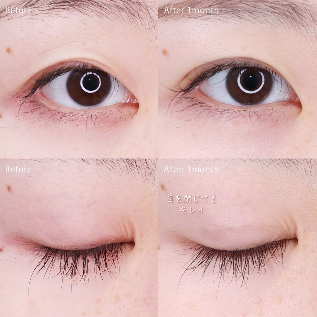 二重埋没法の症例写真 施術前後 