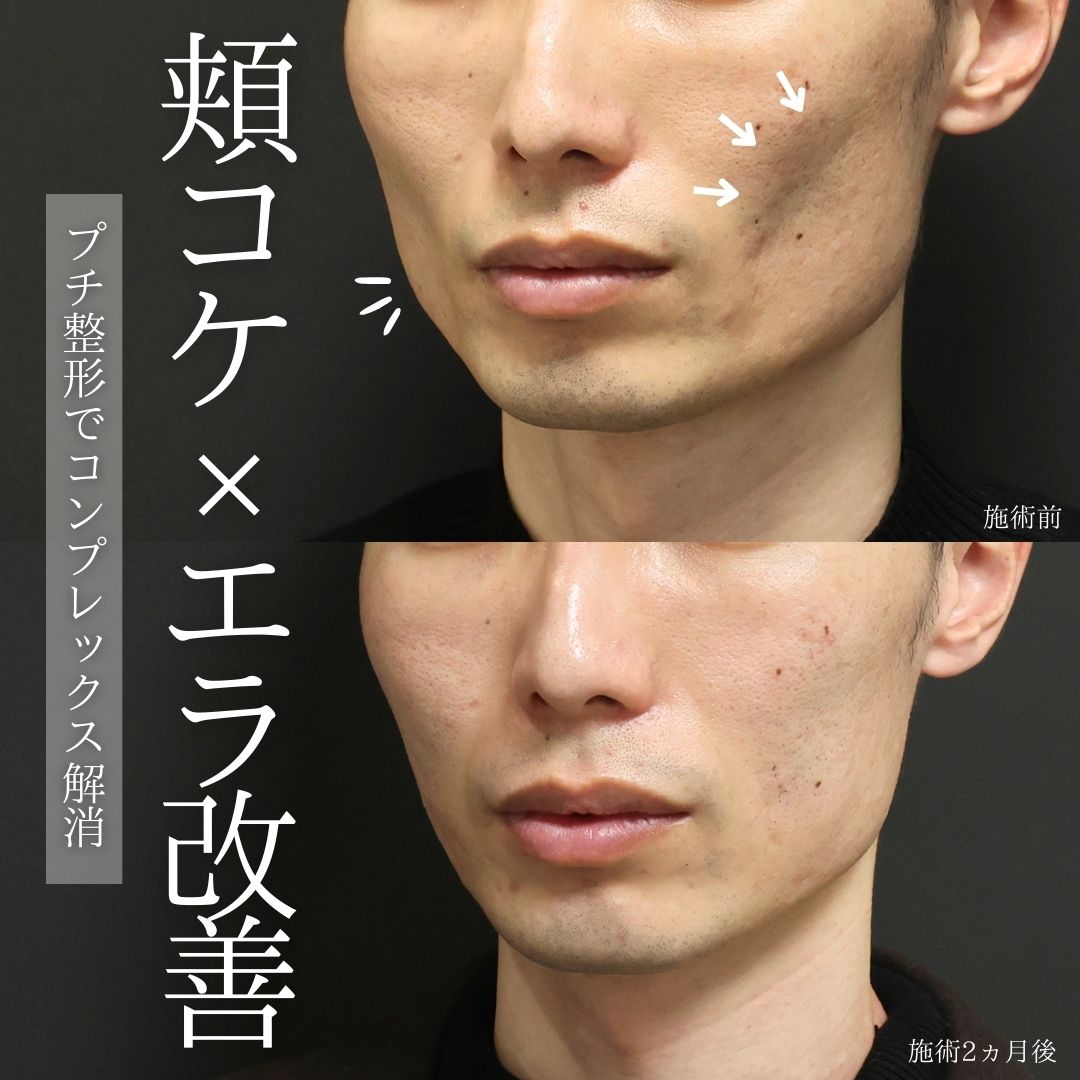 ヒアルロン酸注射：その他/エラボトックス注射の症例写真 施術前後 