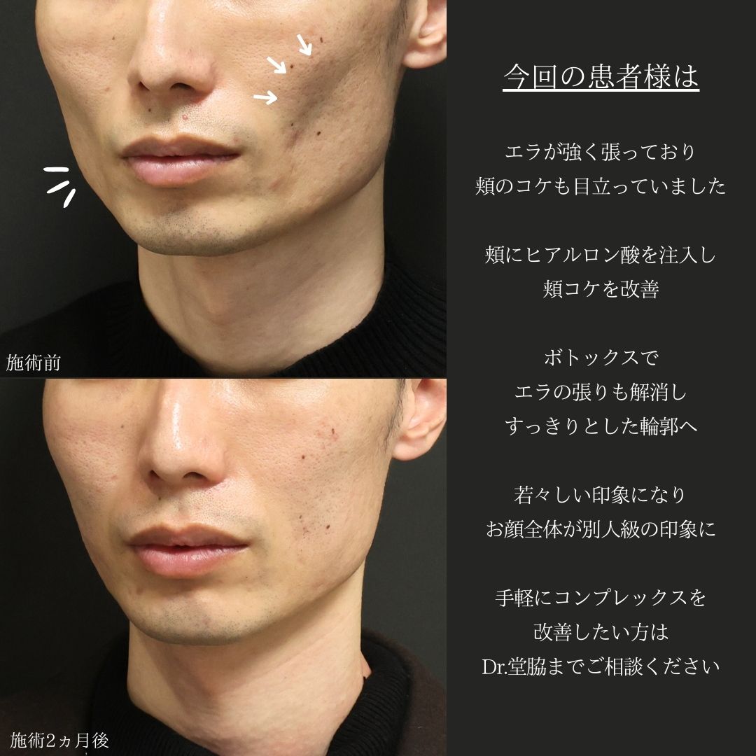 ヒアルロン酸注射：その他/エラボトックス注射の症例写真 施術前後 