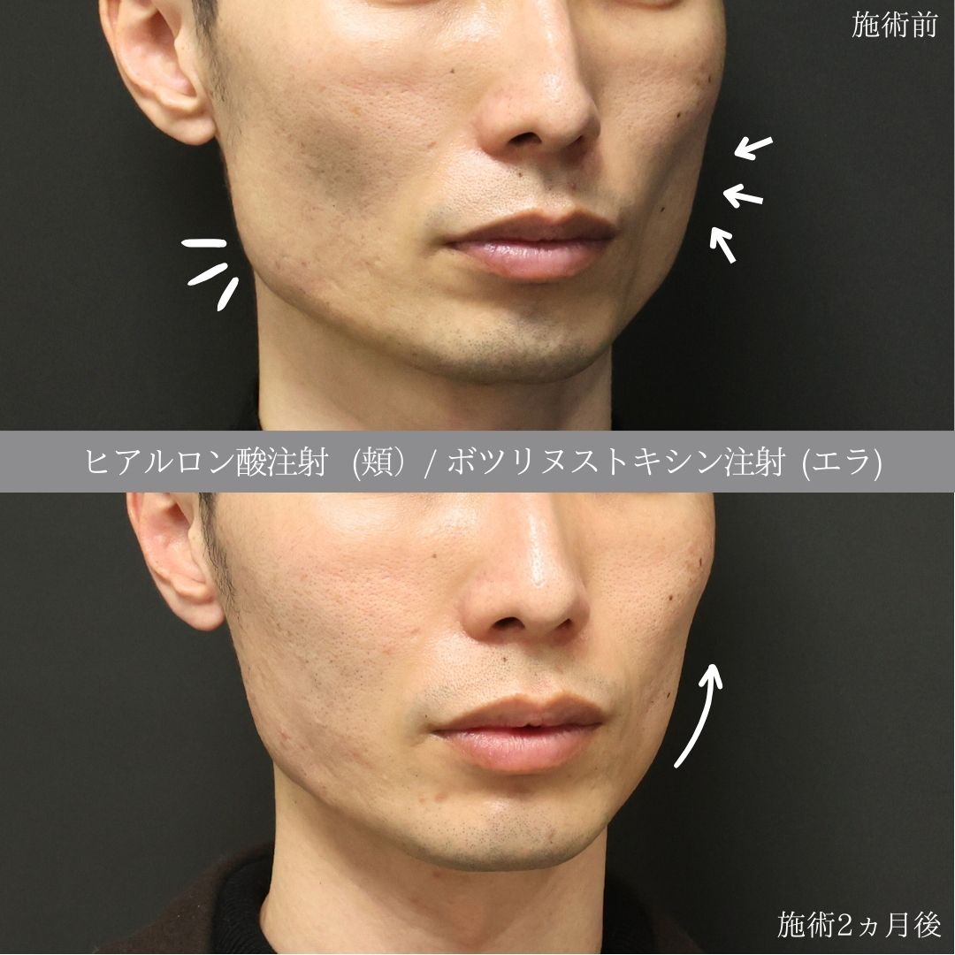 ヒアルロン酸注射：その他/エラボトックス注射の症例写真 施術前後 