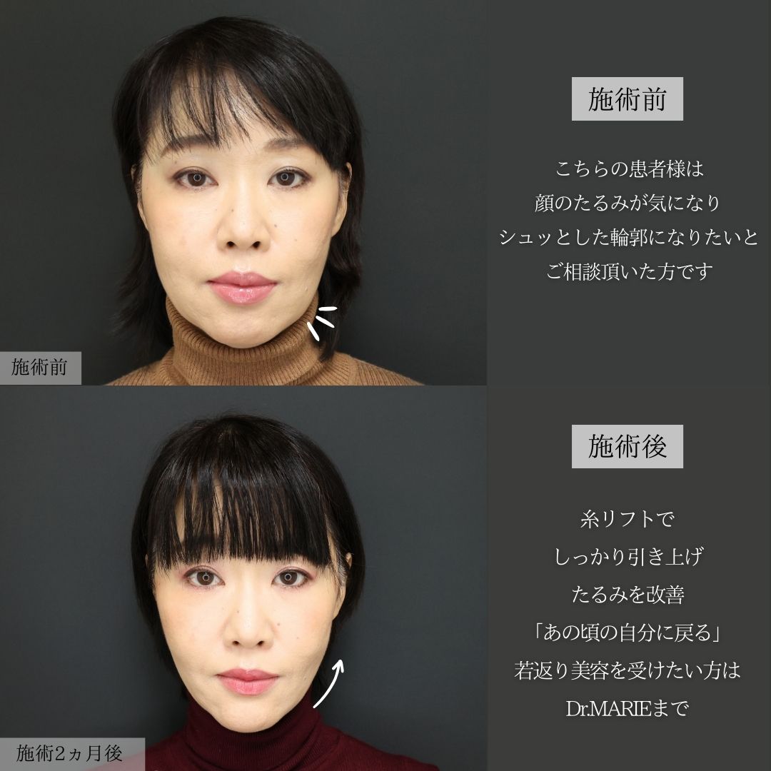 TAC式 ツヤ肌コラーゲンリフト®/ジョールファット除去/ボトックス注射：その他の症例写真 施術前後 