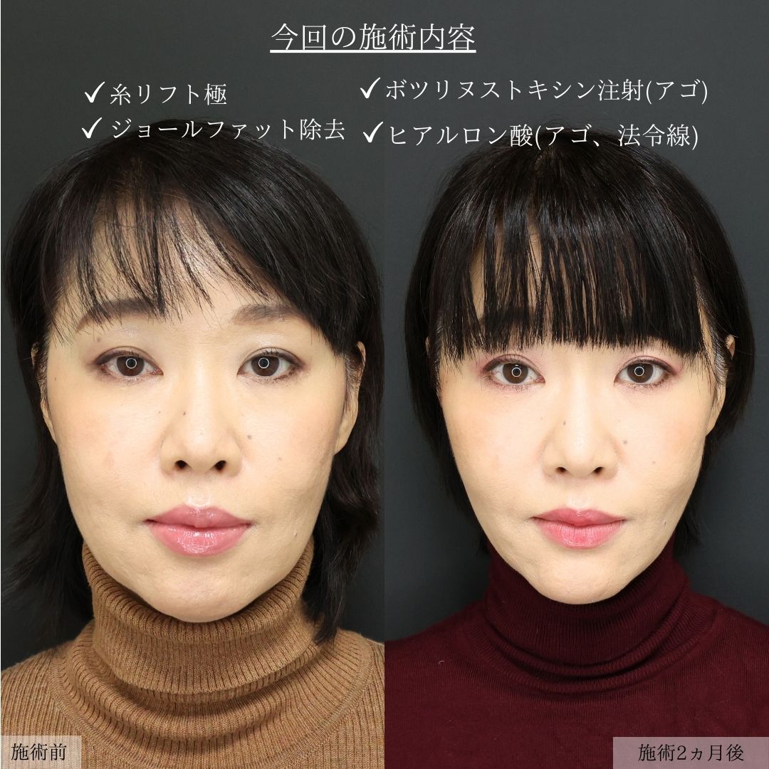 TAC式 ツヤ肌コラーゲンリフト®/ジョールファット除去/ボトックス注射：その他の症例写真 施術前後 