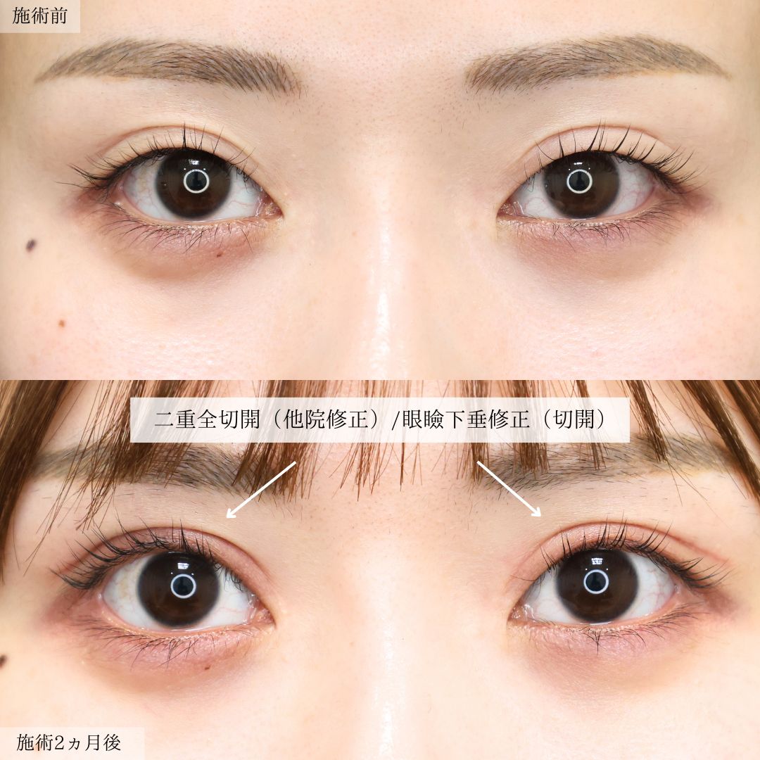 二重切開(全切開法)/上眼瞼切開術/眼瞼下垂(目つき矯正)の症例写真 施術前後