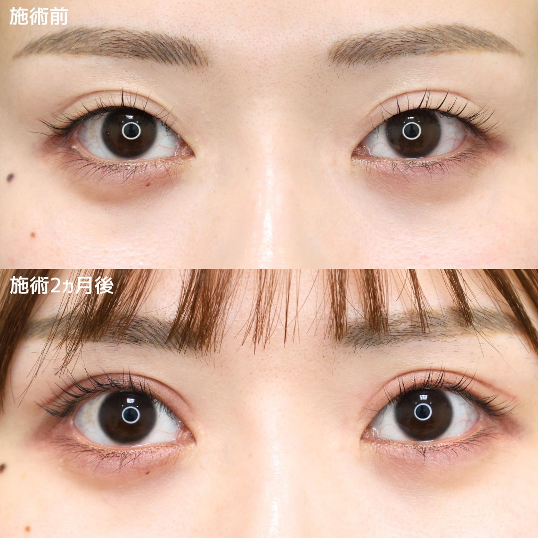 二重切開(全切開法)/上眼瞼切開術/眼瞼下垂(目つき矯正)の症例写真 施術前後