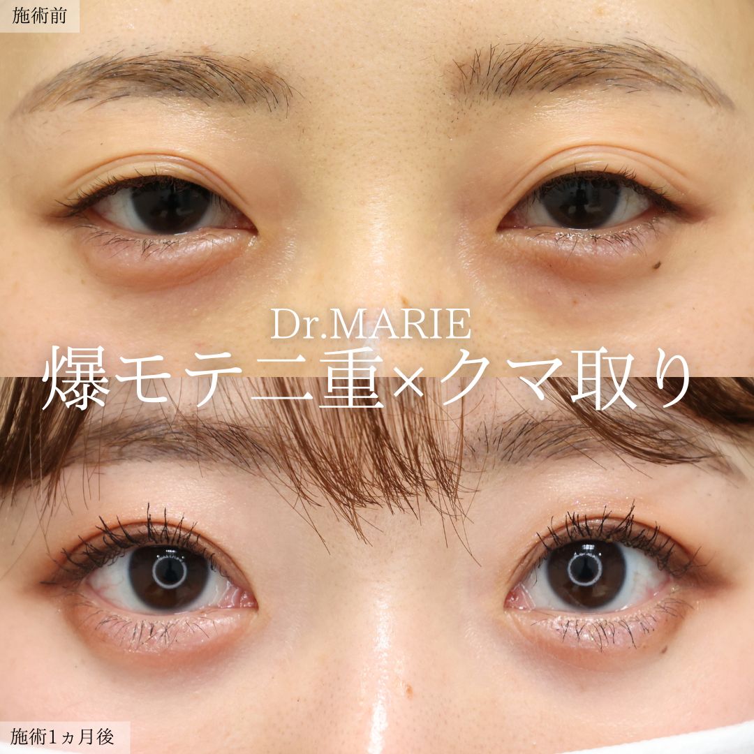 二重埋没法/下眼瞼脱脂術（目の下のたるみ取り・目の下の脂肪ふくらみ取り）の症例写真 施術前後 