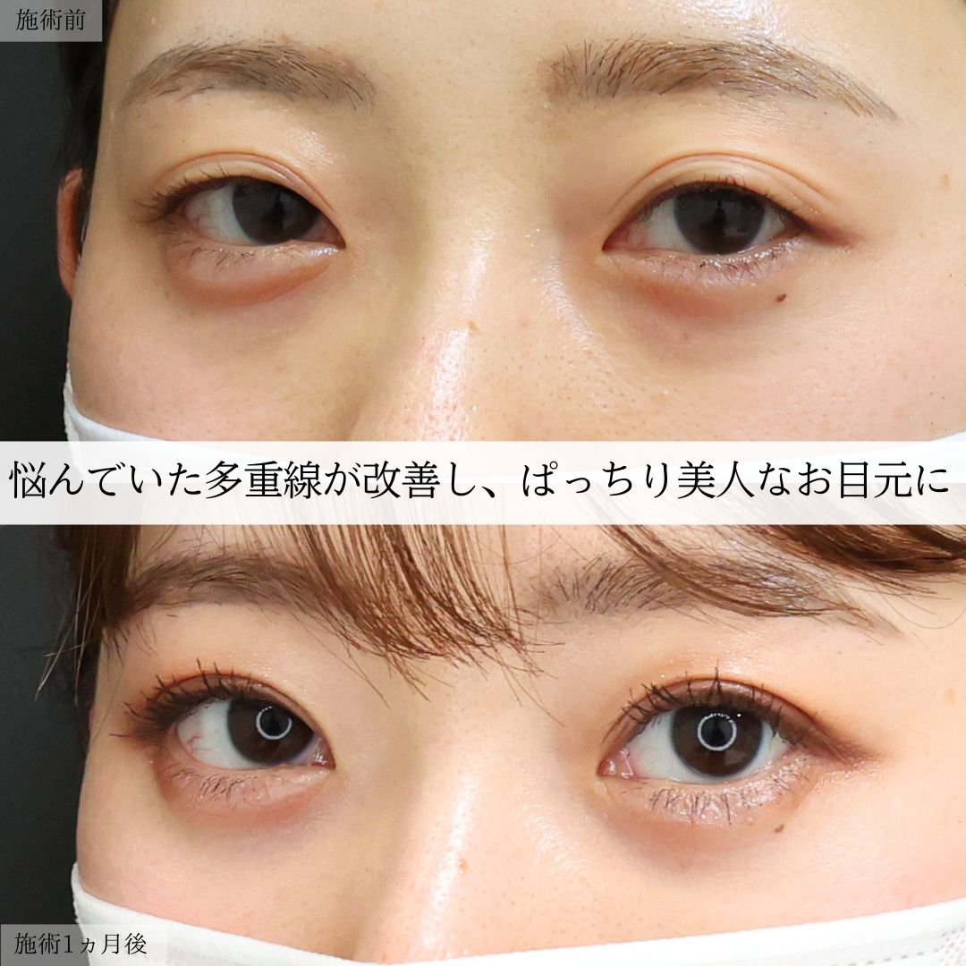 二重埋没法/下眼瞼脱脂術（目の下のたるみ取り・目の下の脂肪ふくらみ取り）の症例写真 施術前後 