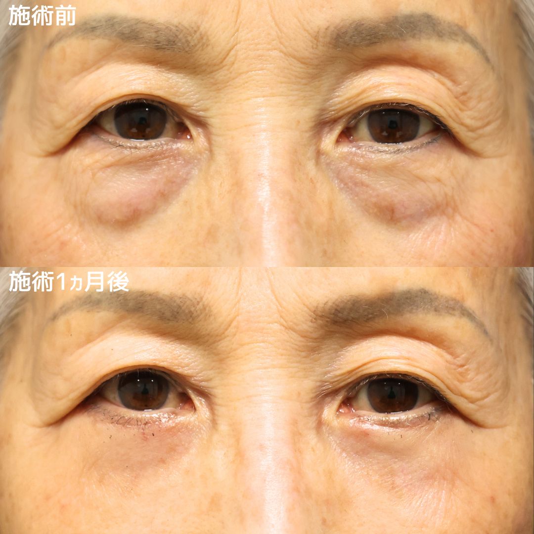 【クマ＋ふくらみ取り】エイジングケアでマイナス10歳見え