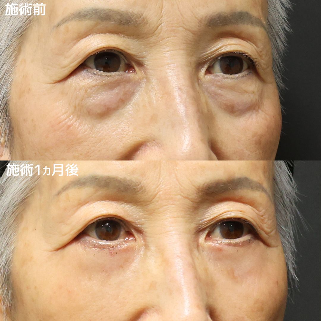 下眼瞼切開術(クマ・たるみとり)/下眼瞼脱脂術(目の下のたるみ取り・目の下の脂肪ふくらみ取り)/顔の脂肪注入(コンデンスリッチフェイス)の症例写真 施術前後