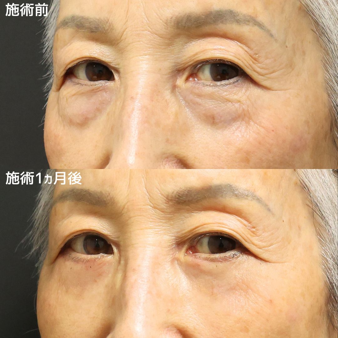 下眼瞼切開術(クマ・たるみとり)/下眼瞼脱脂術(目の下のたるみ取り・目の下の脂肪ふくらみ取り)/顔の脂肪注入(コンデンスリッチフェイス)の症例写真 施術前後