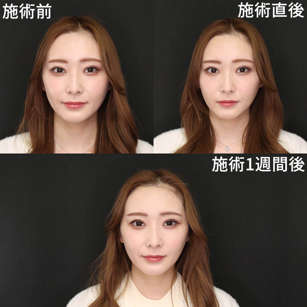 TAC式 ツヤ肌コラーゲンリフト®の症例写真 施術前後 