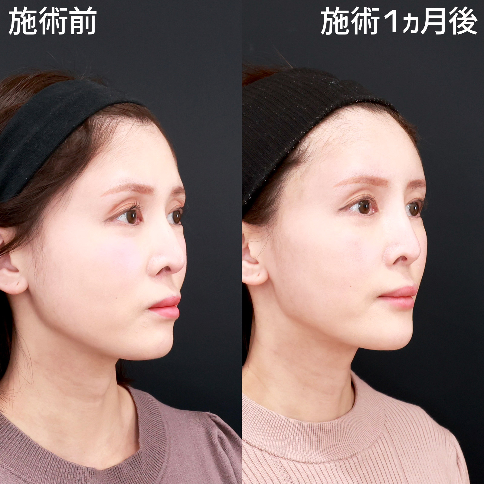 【コンデンスリッチ脂肪注入】凹み改善しつつ、丸く女性らしいおでこを形成！