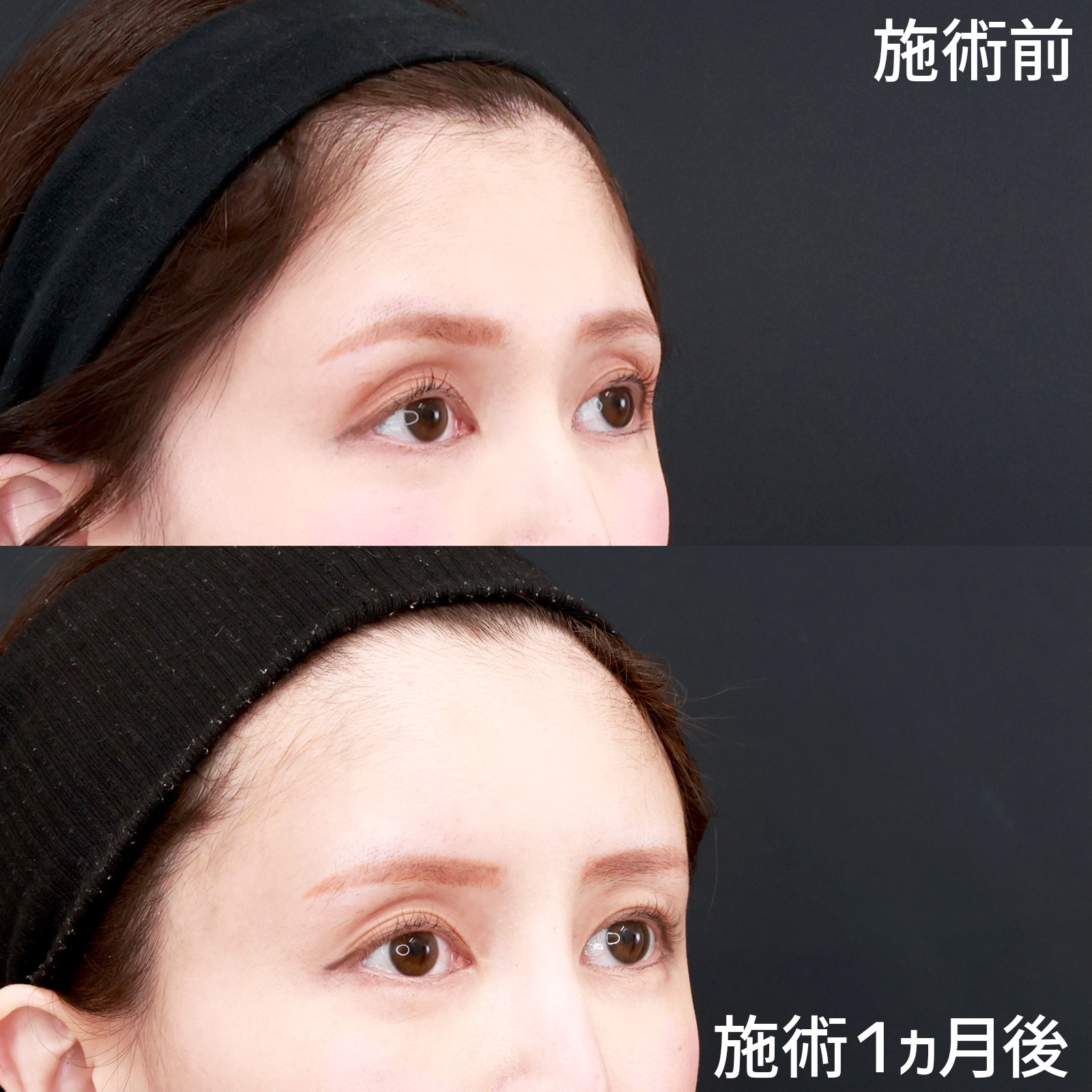 鼻のヒアルロン酸注射/おでこの脂肪注入(オルチャンデコ形成)/顔の脂肪注入(コンデンスリッチフェイス)の症例写真 施術前後