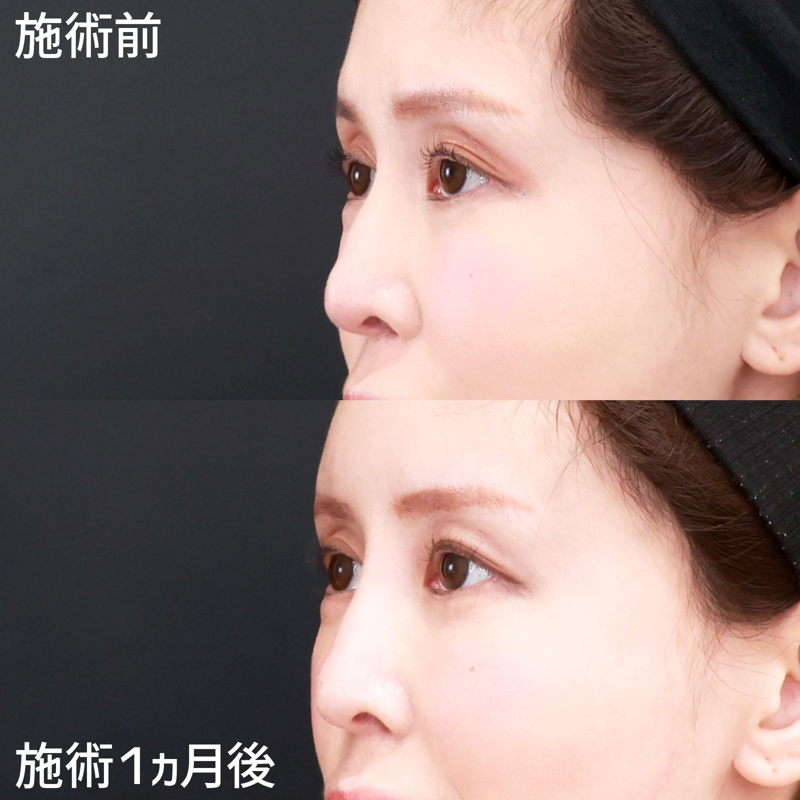 鼻のヒアルロン酸注射/おでこの脂肪注入(オルチャンデコ形成)/顔の脂肪注入(コンデンスリッチフェイス)の症例写真 施術前後