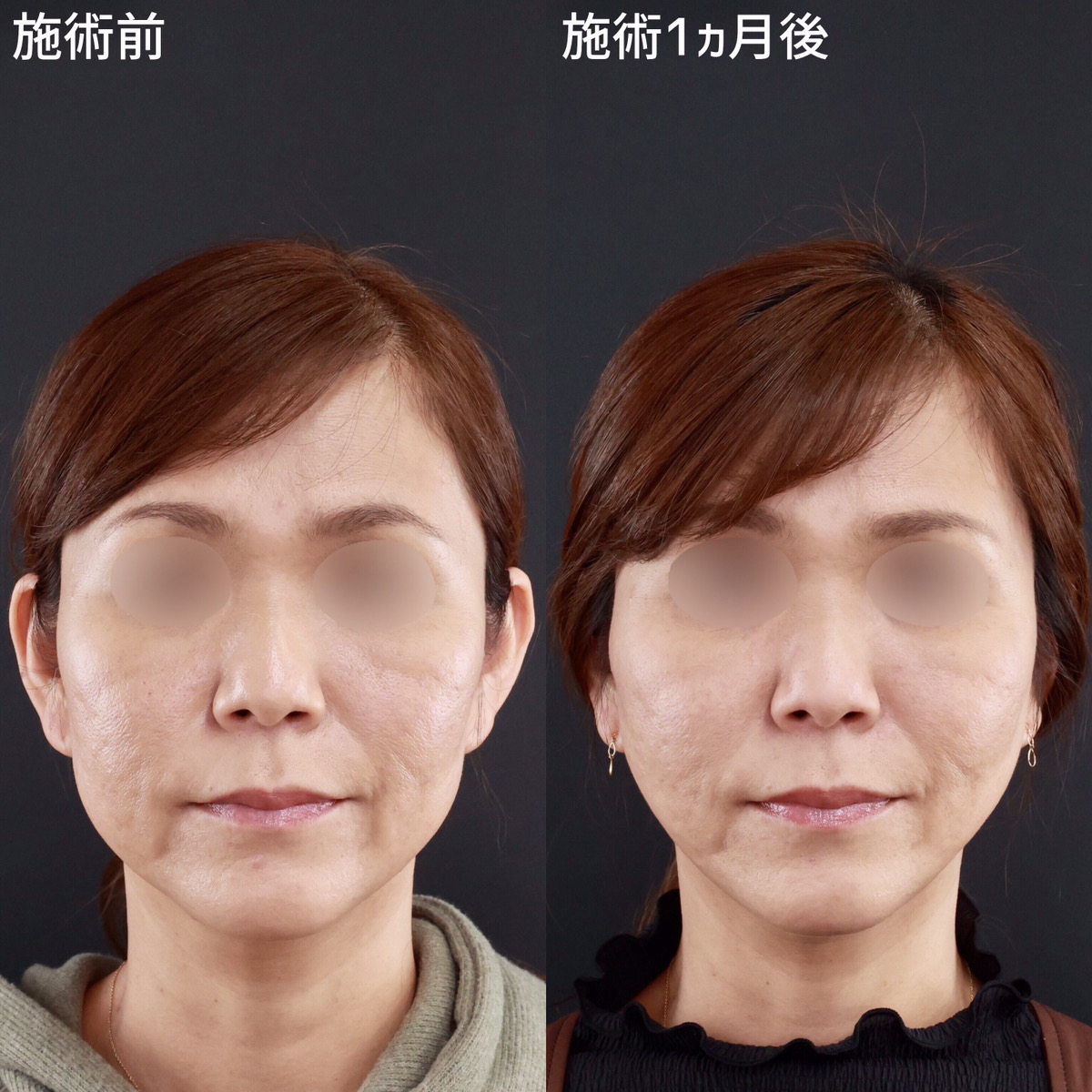 【小顔整形】鏡を見たくなるようなフェイスラインへ