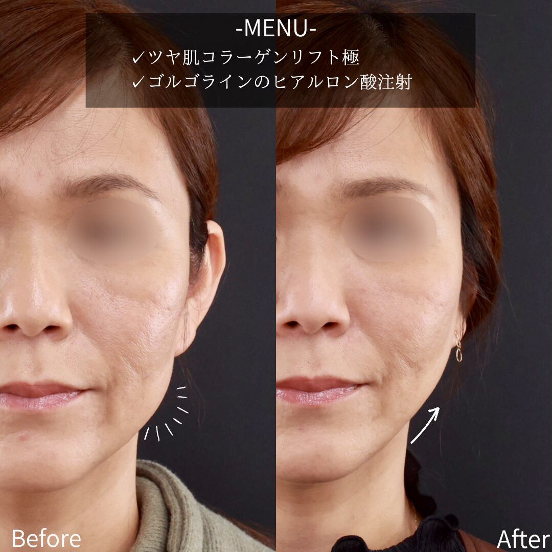 TAC式 ツヤ肌コラーゲンリフト®/ゴルゴ線のヒアルロン酸注射の症例写真 施術前後 