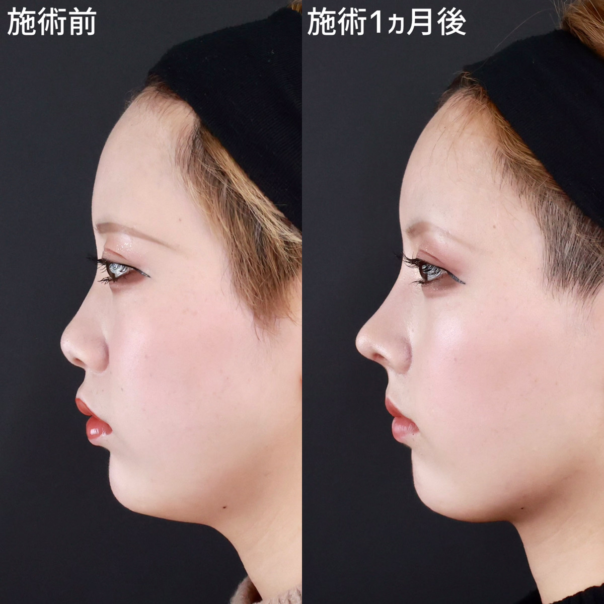 鼻尖形成・鼻尖縮小/鼻先軟骨移植/鼻中隔延長術の症例写真 施術前後 