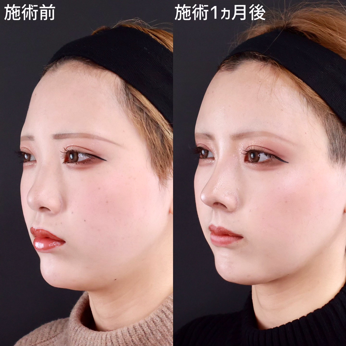 鼻尖形成・鼻尖縮小/鼻先軟骨移植/鼻中隔延長術の症例写真 施術前後 