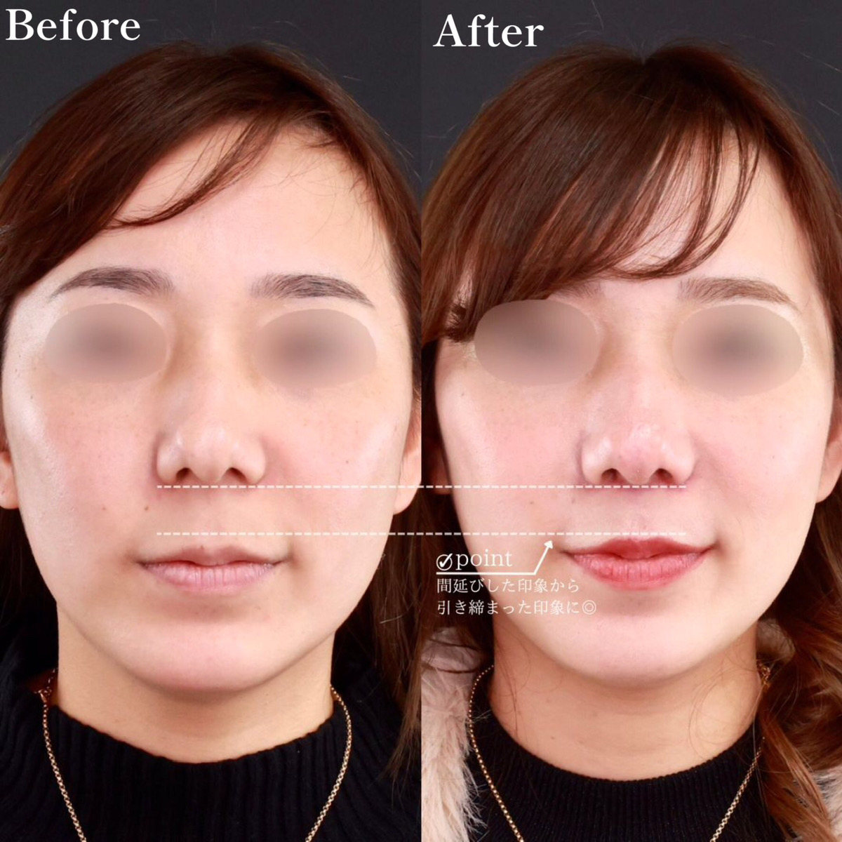 人中短縮術(リップリフト)・外側人中短縮術の症例写真 施術前後 