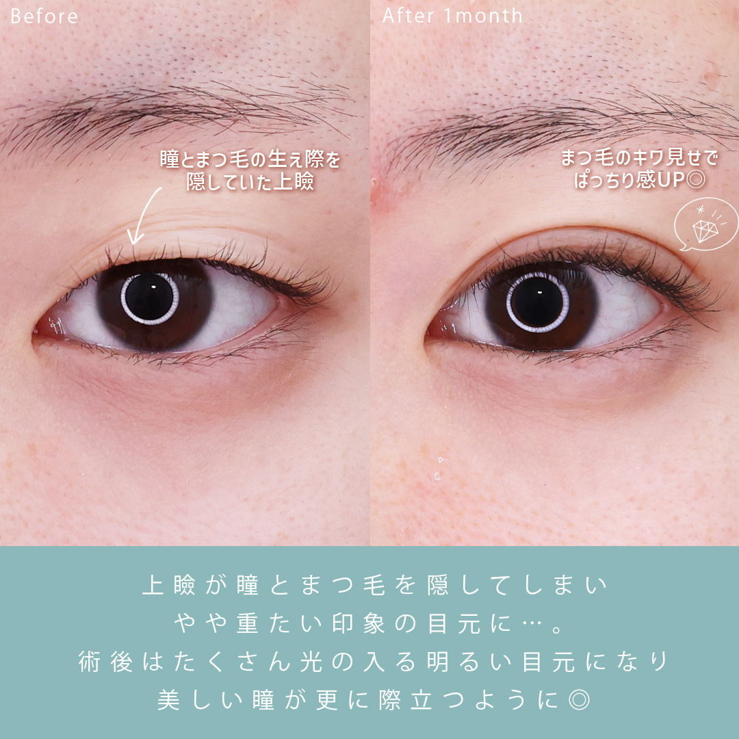 二重埋没法の症例写真 施術前後 