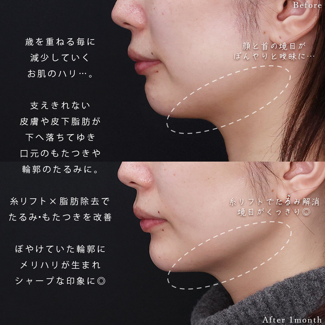 小顔整形｜パーフェクトフェイスライン/TAC式 ツヤ肌コラーゲンリフト®/ジョールファット除去の症例写真 施術前後 
