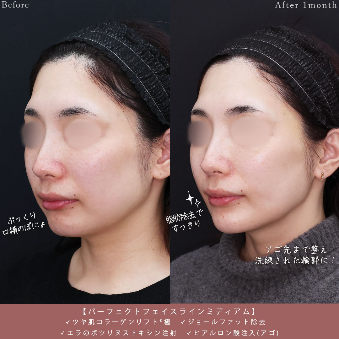 小顔整形｜パーフェクトフェイスライン/TAC式 ツヤ肌コラーゲンリフト®/ジョールファット除去の症例写真 施術前後 