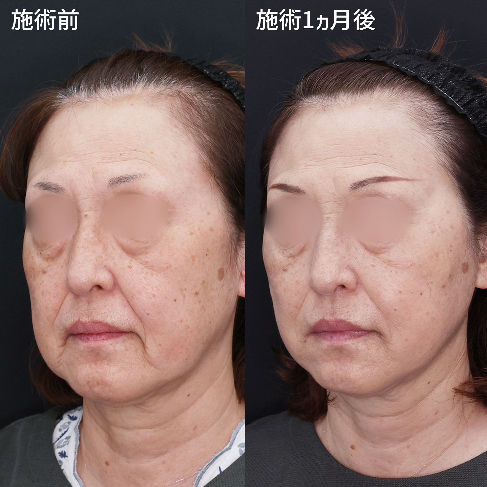 【糸リフト】でたるみ引き上げ、若々しさ甦る！