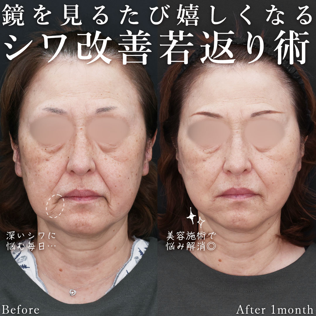 TAC式 ツヤ肌コラーゲンリフト®の症例写真 施術前後 