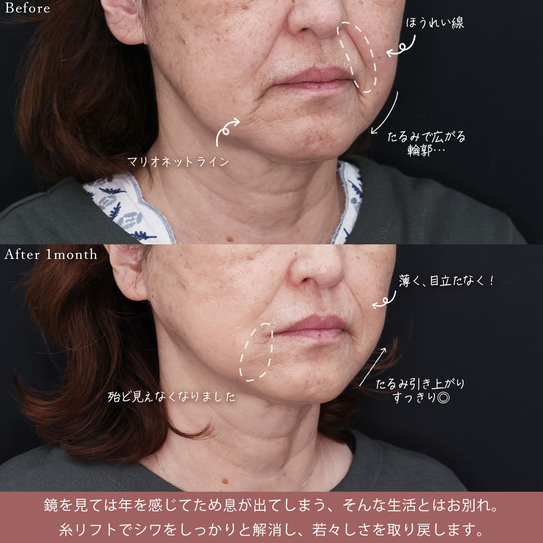 TAC式 ツヤ肌コラーゲンリフト®の症例写真 施術前後 