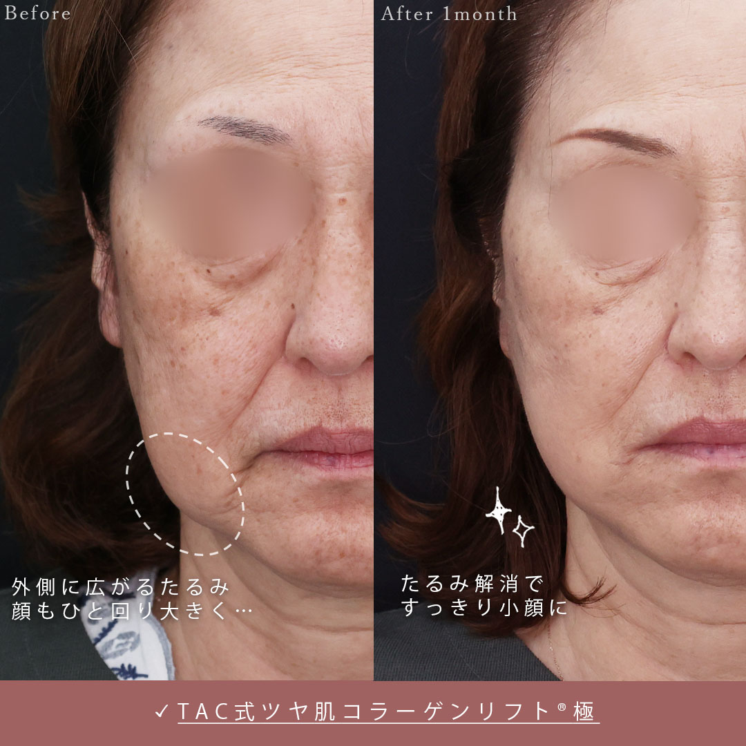 TAC式 ツヤ肌コラーゲンリフト®の症例写真 施術前後 