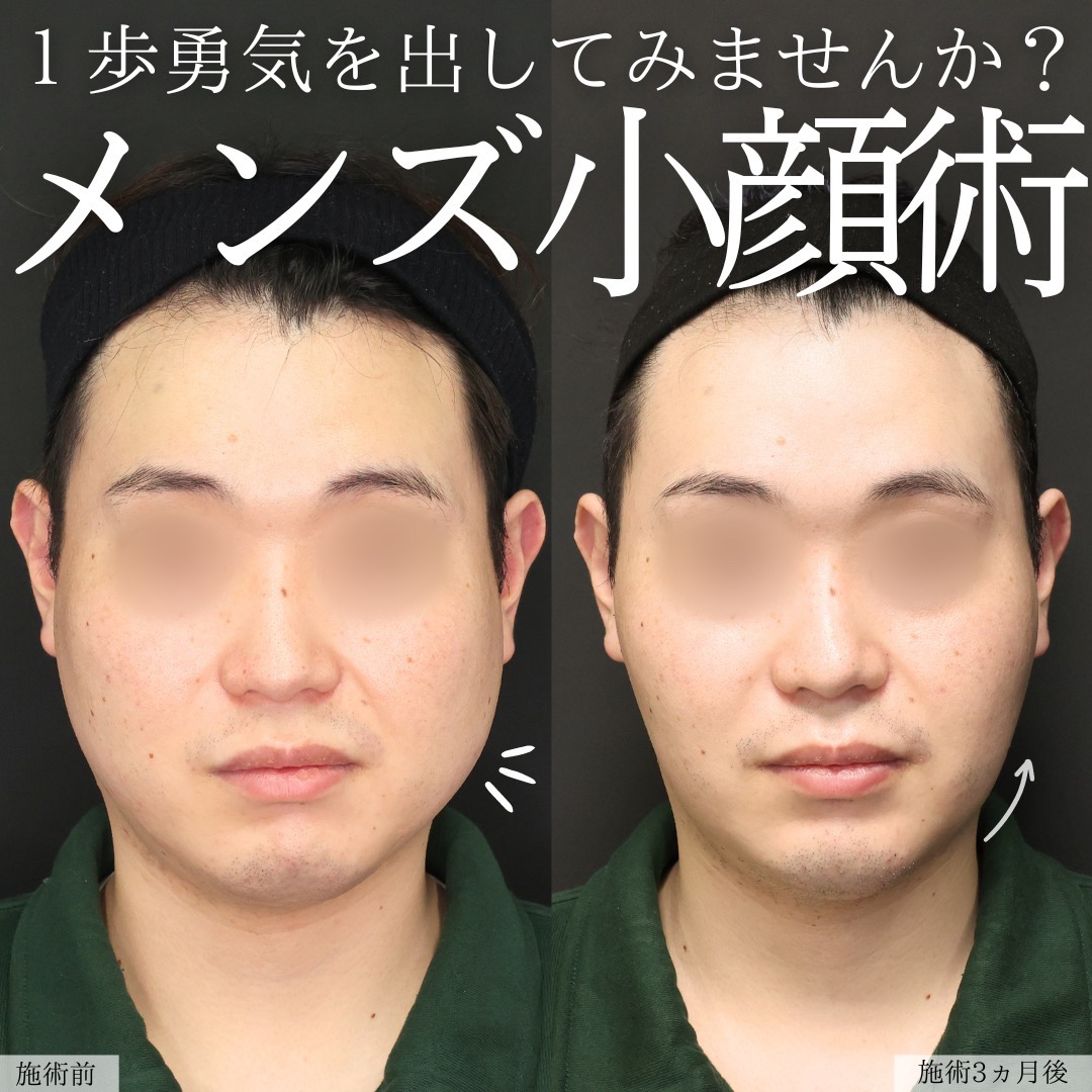 TAC式 ツヤ肌コラーゲンリフト®/ジョールファット除去/バッカルファット除去の症例写真 施術前後 