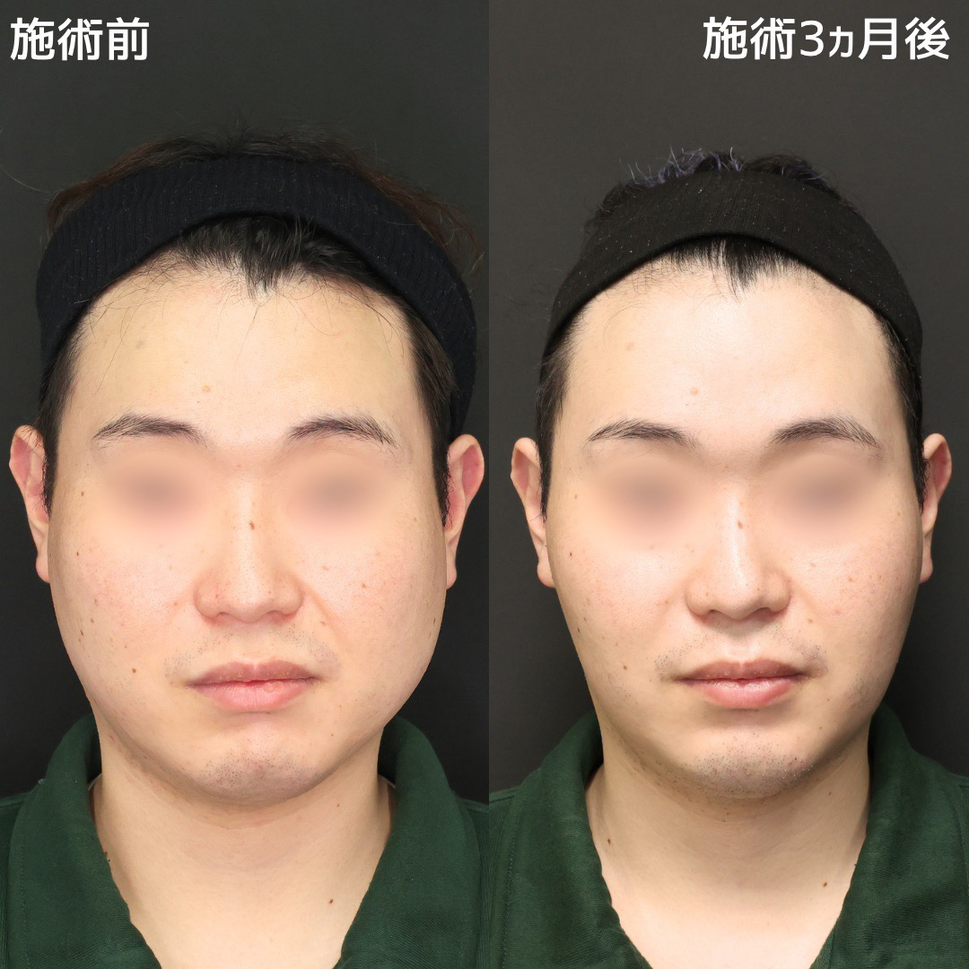 【小顔複合施術】で一回り小さいすっきり小顔に