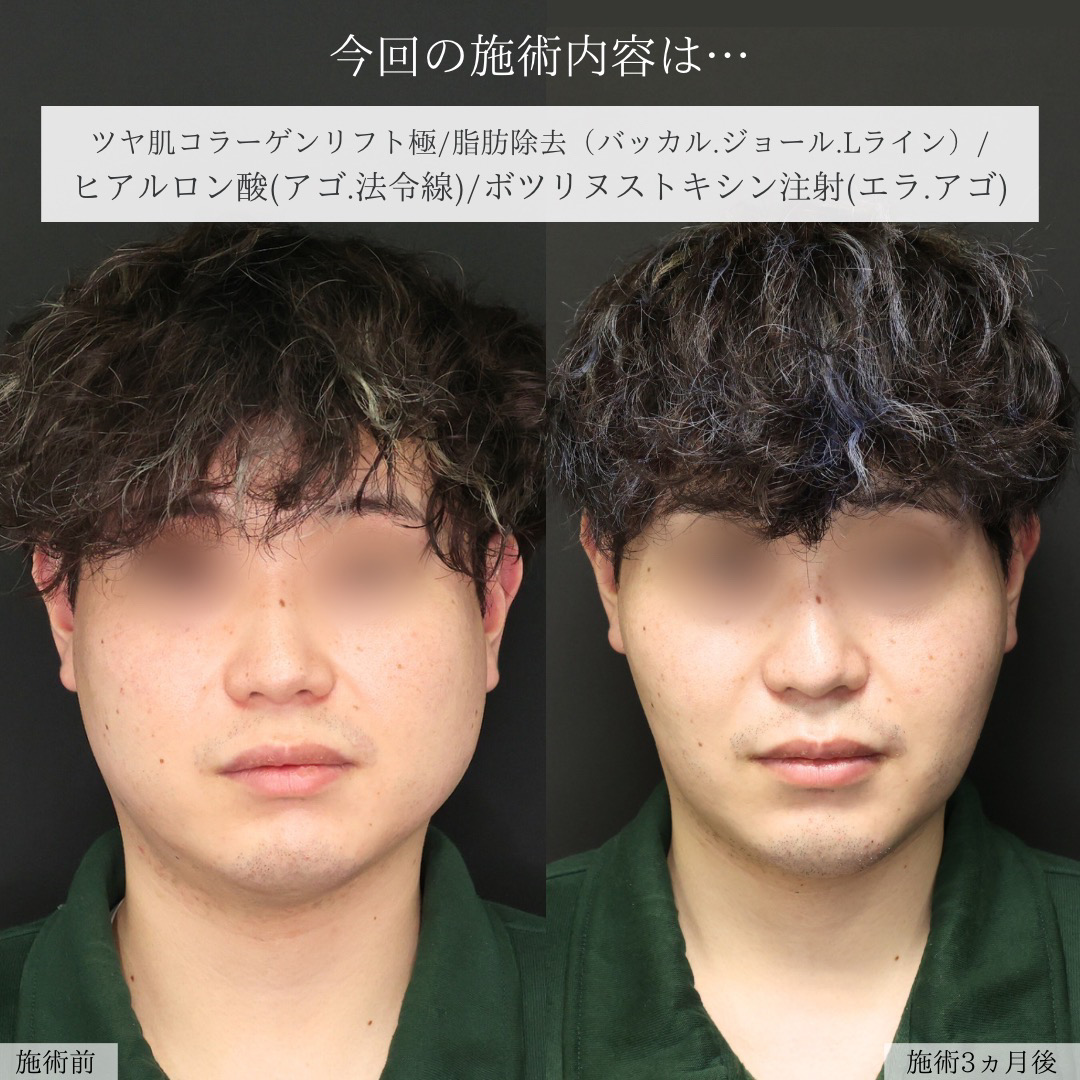 TAC式 ツヤ肌コラーゲンリフト®/ジョールファット除去/バッカルファット除去の症例写真 施術前後 