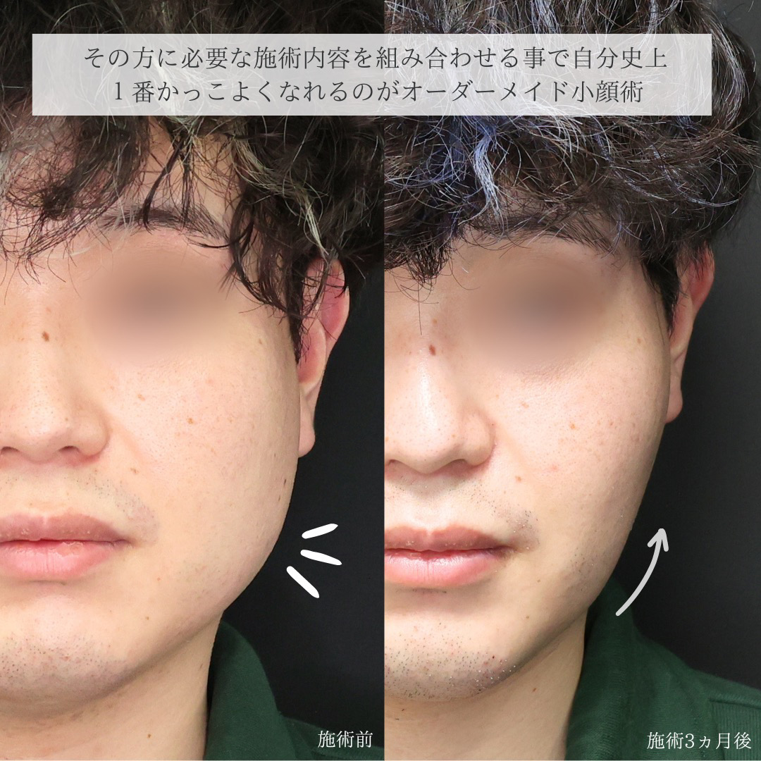 TAC式 ツヤ肌コラーゲンリフト®/ジョールファット除去/バッカルファット除去の症例写真 施術前後 