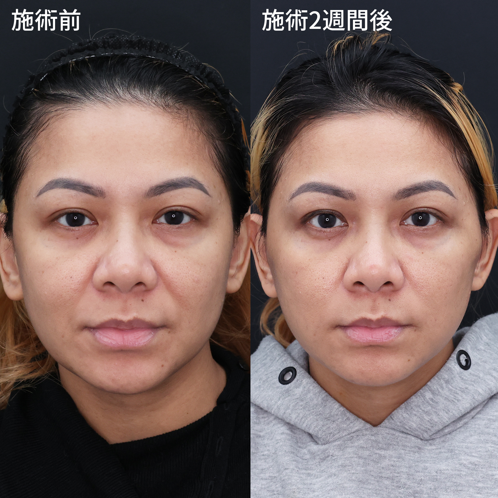 若返り×小顔を叶える【糸リフト】