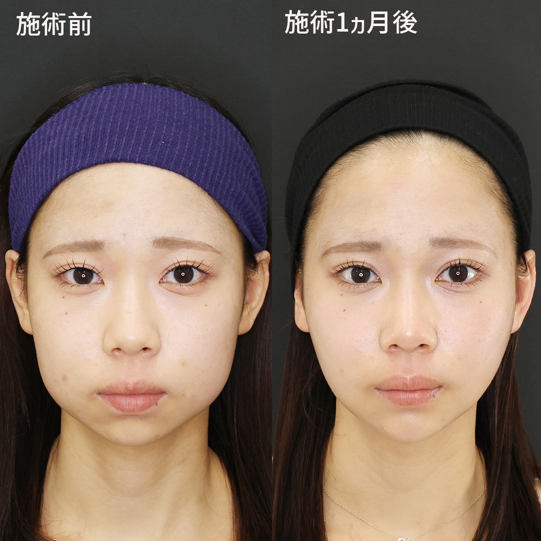 【骨切りなしでここまで変化】憧れの卵型輪郭