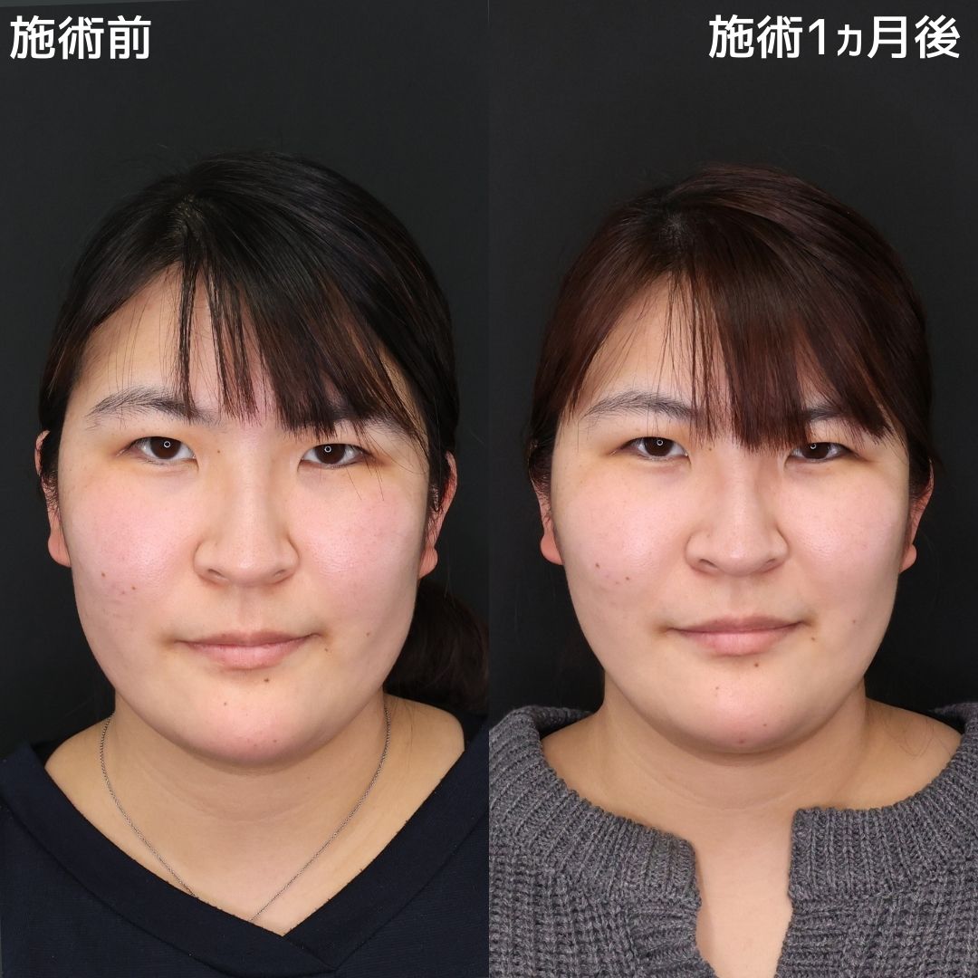 【小顔複合施術】ナチュラルに小顔へ