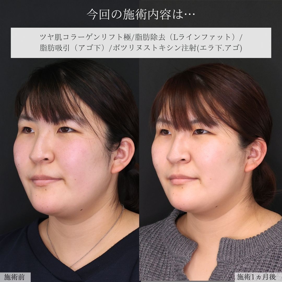 TAC式 ツヤ肌コラーゲンリフト®/Lラインファット除去（エラ下脂肪除去）/エラボトックス注射の症例写真 施術前後 
