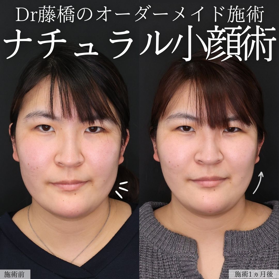 TAC式 ツヤ肌コラーゲンリフト®/Lラインファット除去（エラ下脂肪除去）/エラボトックス注射の症例写真 施術前後 